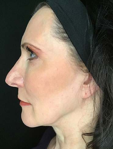 Patient #65054: Liquid Facelift After Image