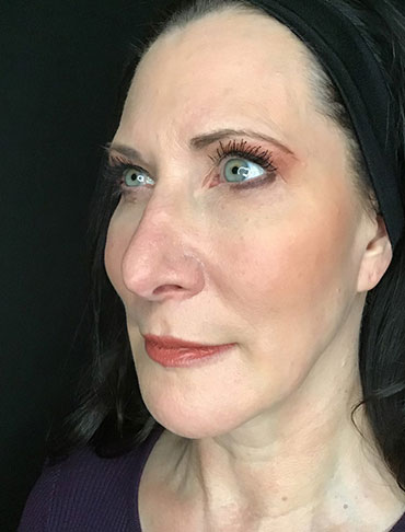 Patient #65054: Liquid Facelift After Image