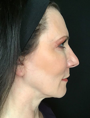 Patient #65054: Liquid Facelift After Image