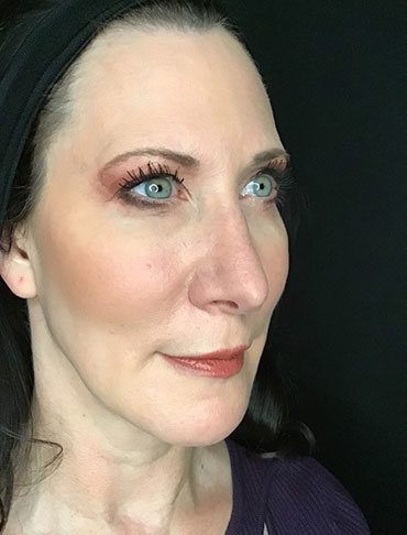 Patient #65054: Liquid Facelift After Image