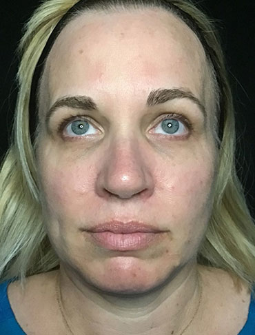 Patient #92997: Liquid Facelift Before Image