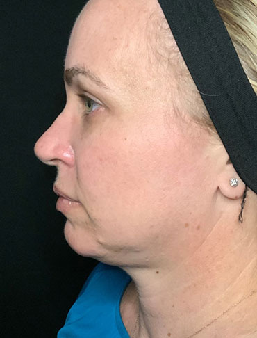 Patient #92997: Liquid Facelift Before Image