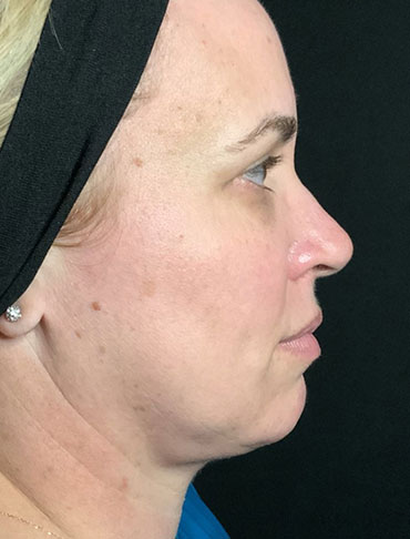 Patient #92997: Liquid Facelift Before Image