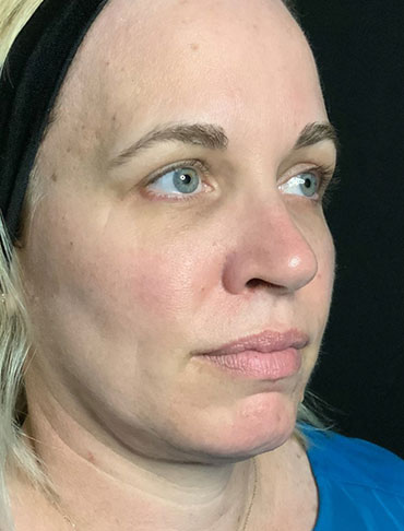 Patient #92997: Liquid Facelift Before Image