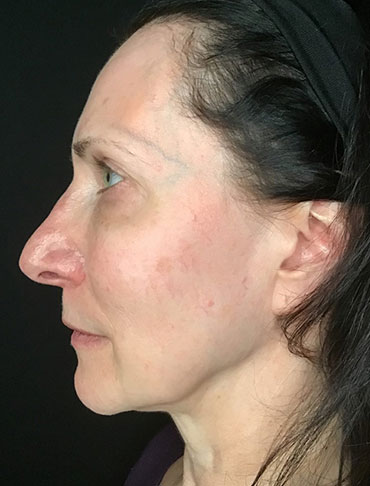 Patient #65054: Liquid Facelift Before Image
