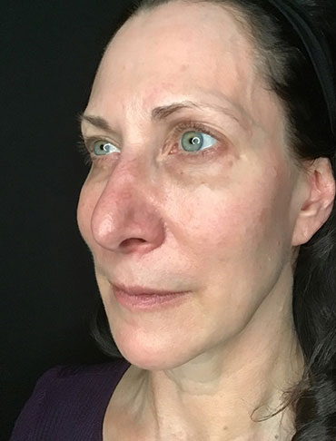 Patient #65054: Liquid Facelift Before Image