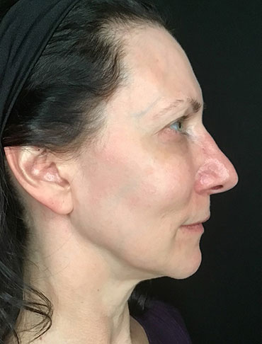 Patient #65054: Liquid Facelift Before Image