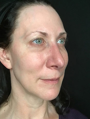 Patient #65054: Liquid Facelift Before Image