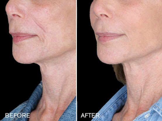 Patient #3: Renuva Fat Stimulation Combine Image