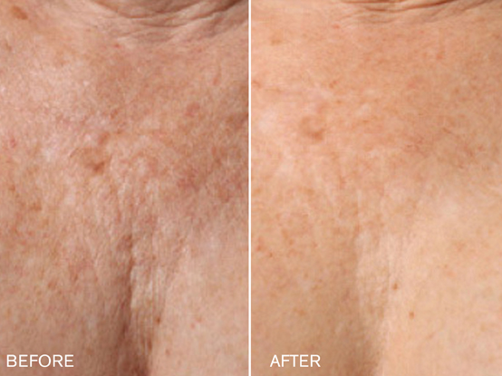 Patient #2: Renuva Fat Stimulation Combine Image