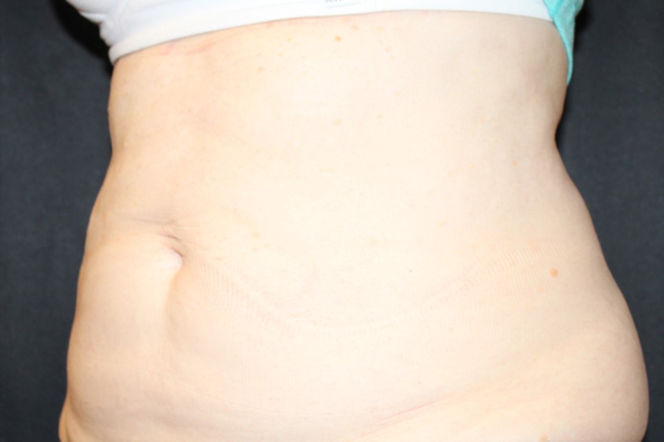 Patient #13800: CoolSculpting After Image