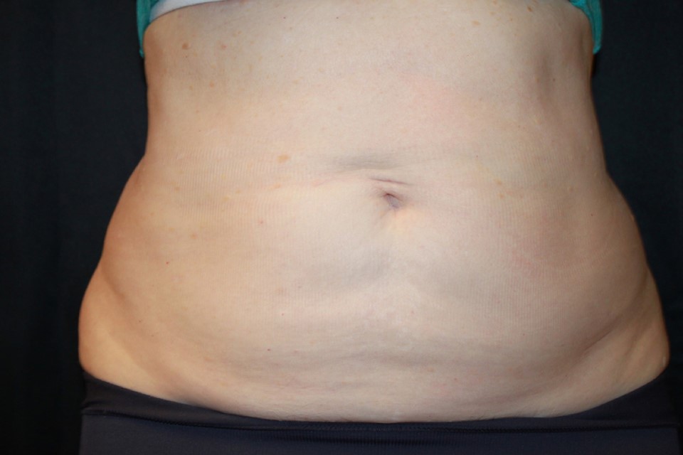 Patient #13800: CoolSculpting After Image