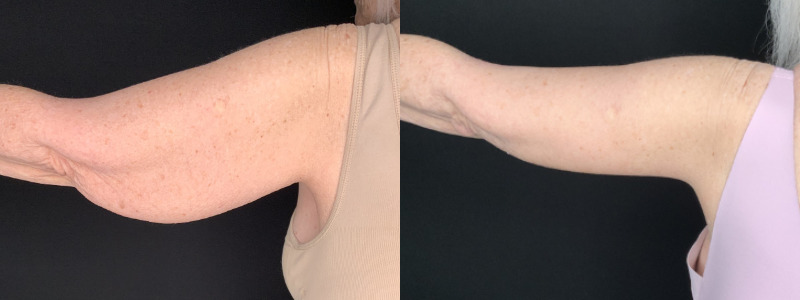 Patient #32785: Brachioplasty Combine Image