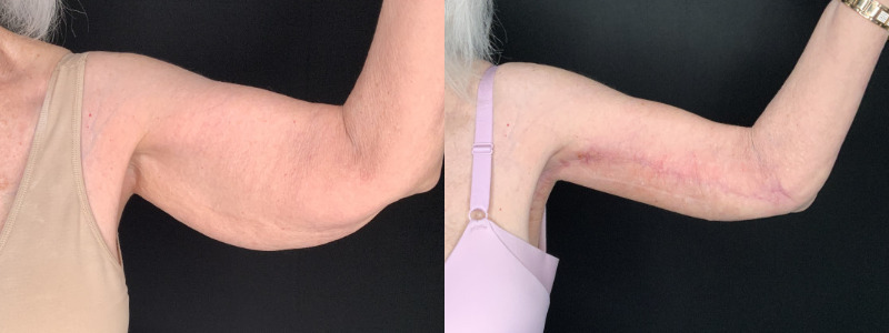 Patient #32785: Brachioplasty Combine Image