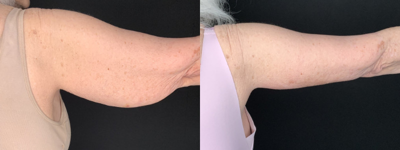 Patient #32785: Brachioplasty Combine Image