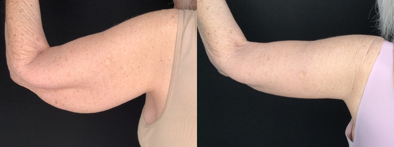 Patient #32785: Brachioplasty Combine Image
