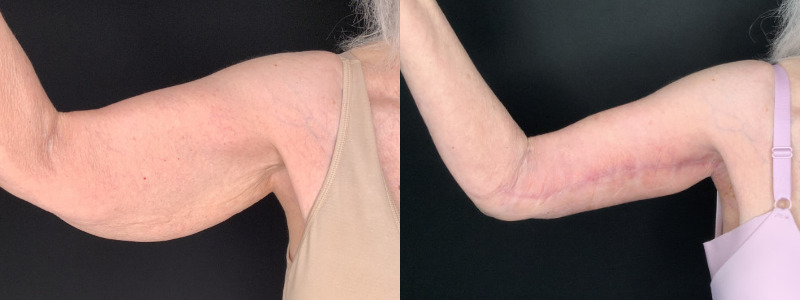 Patient #32785: Brachioplasty Combine Image