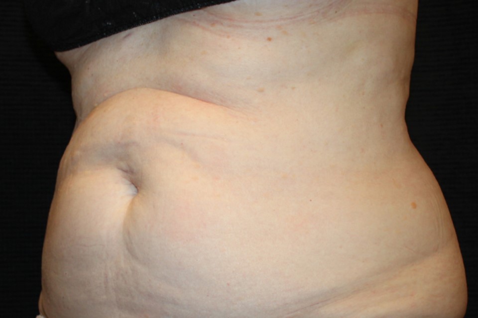 Patient #13800: CoolSculpting Before Image