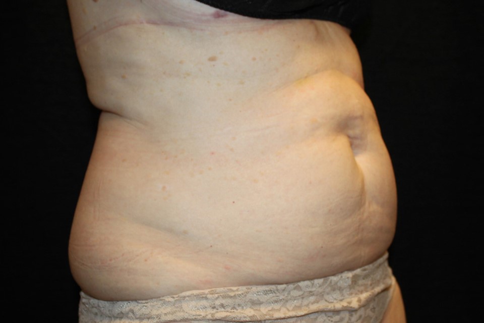 Patient #13800: CoolSculpting Before Image