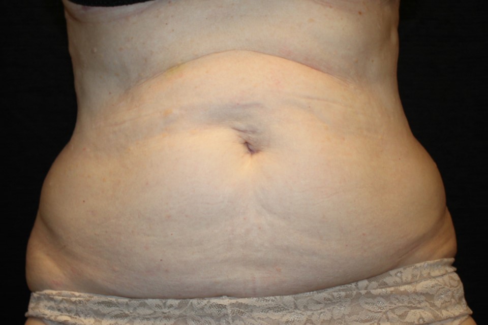 Patient #13800: CoolSculpting Before Image