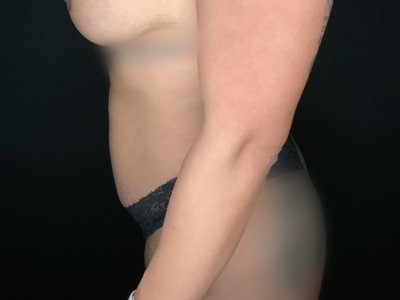 Paciente n.° 89674-2: Imagen posterior a la aplicación de BodyTite