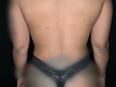 Paciente n.° 89674-2: Imagen posterior a la aplicación de BodyTite