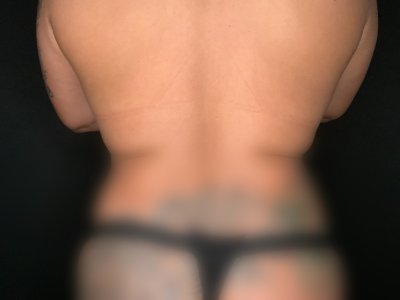 Paciente n.° 89674-2: Imagen previa al tratamiento con BodyTite