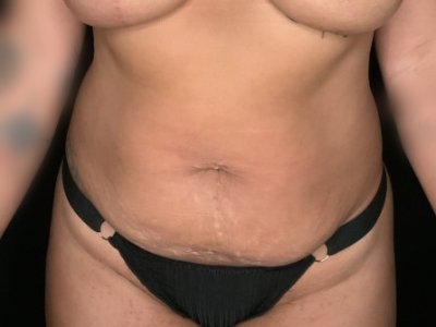 Paciente n.° 89674-2: Imagen previa al tratamiento con BodyTite
