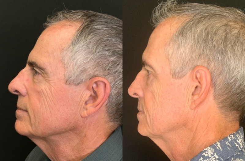 Patient #12546: Botox Combine Image