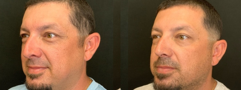 Patient #24587: Botox Combine Image