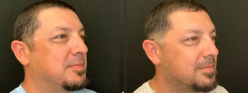 Patient #24587: Botox Combine Image