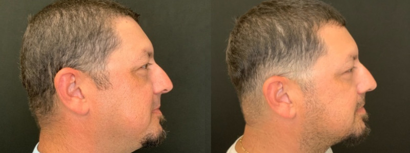 Patient #24587: Botox Combine Image