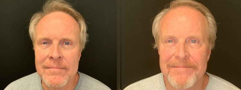 Patient #85427: Botox Combine Image