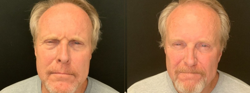 Patient #85427: Botox Combine Image