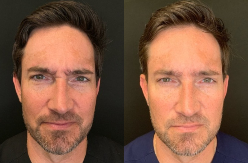Patient #23598: Botox Combine Image