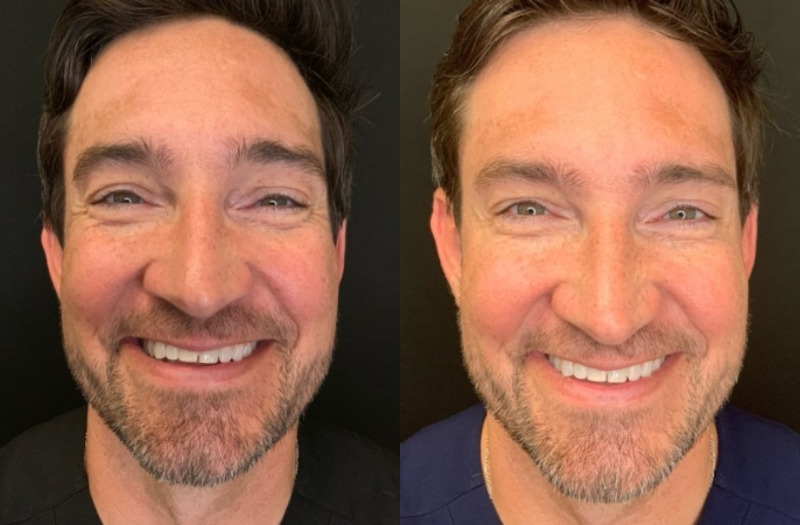 Patient #23598: Botox Combine Image