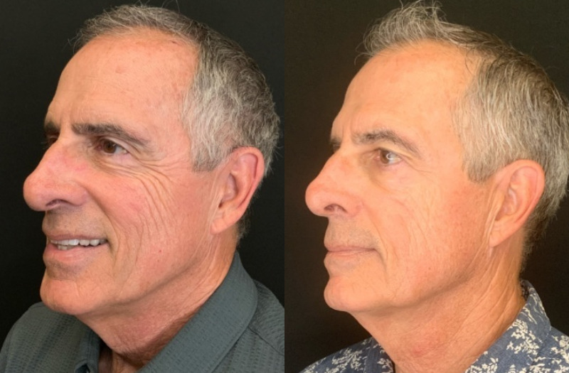 Patient #12546: Botox Combine Image