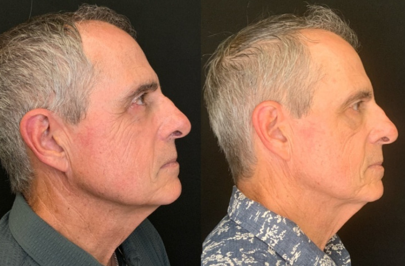 Patient #12546: Botox Combine Image