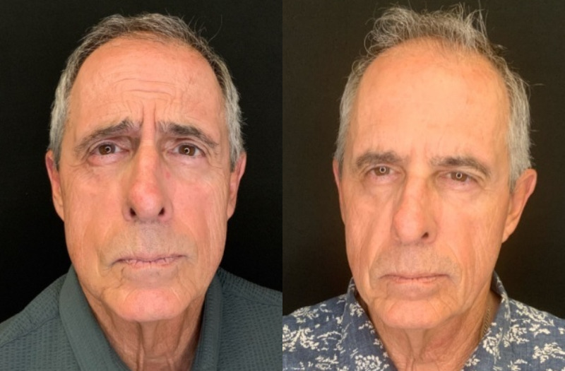 Patient #12546: Botox Combine Image