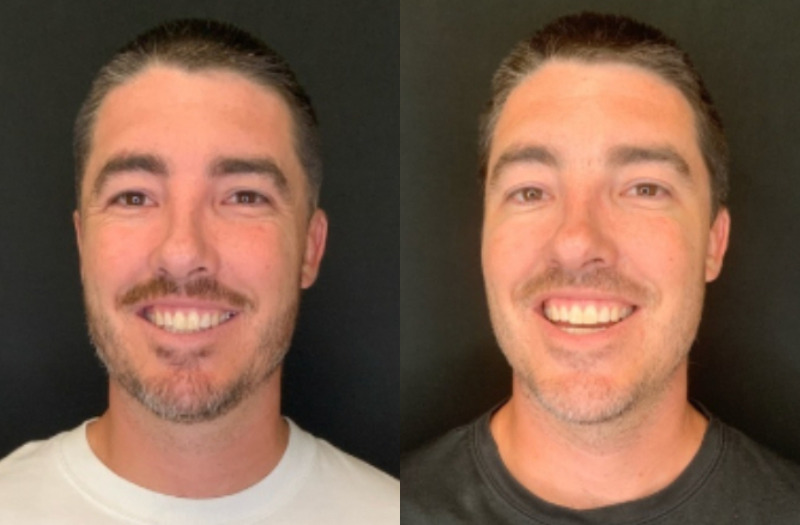 Patient #54875: Botox Combine Image