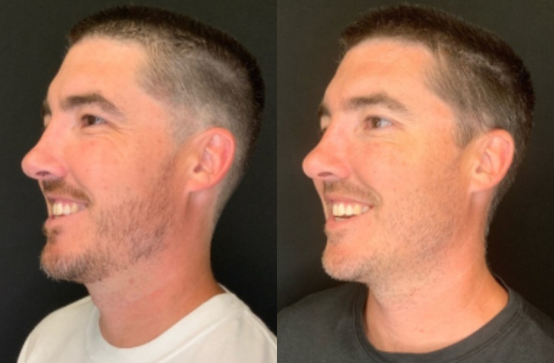 Patient #54875: Botox Combine Image