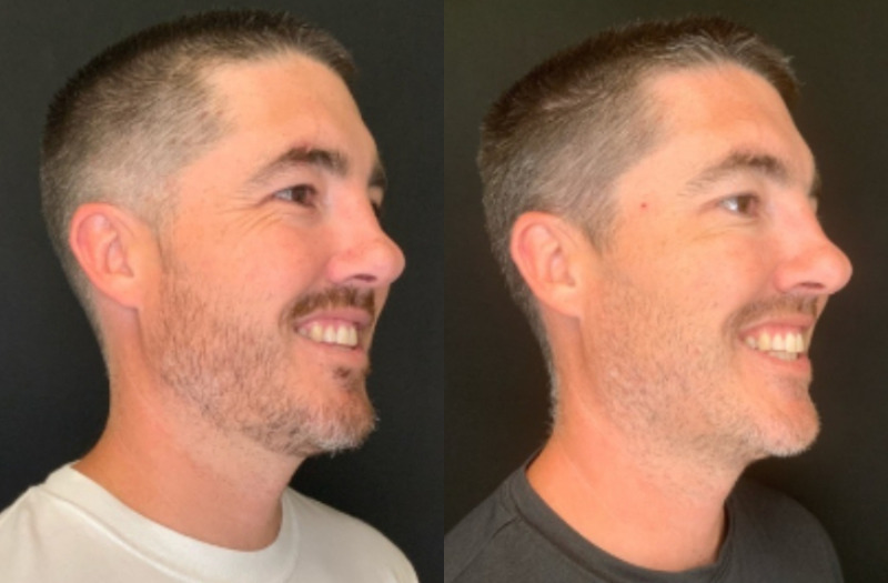 Patient #54875: Botox Combine Image