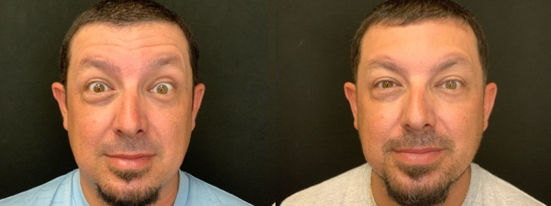 Patient #24587: Botox Combine Image