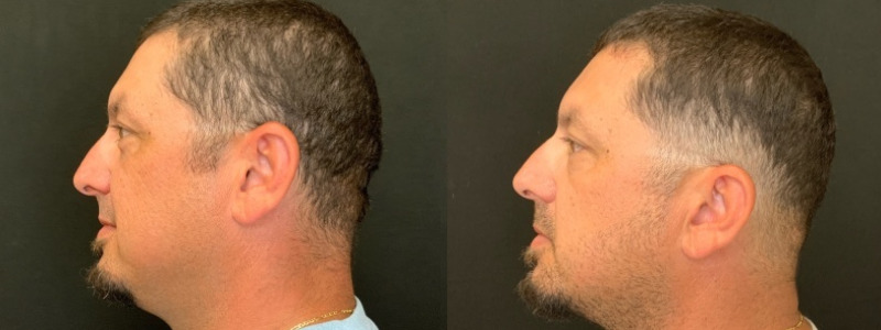 Patient #24587: Botox Combine Image