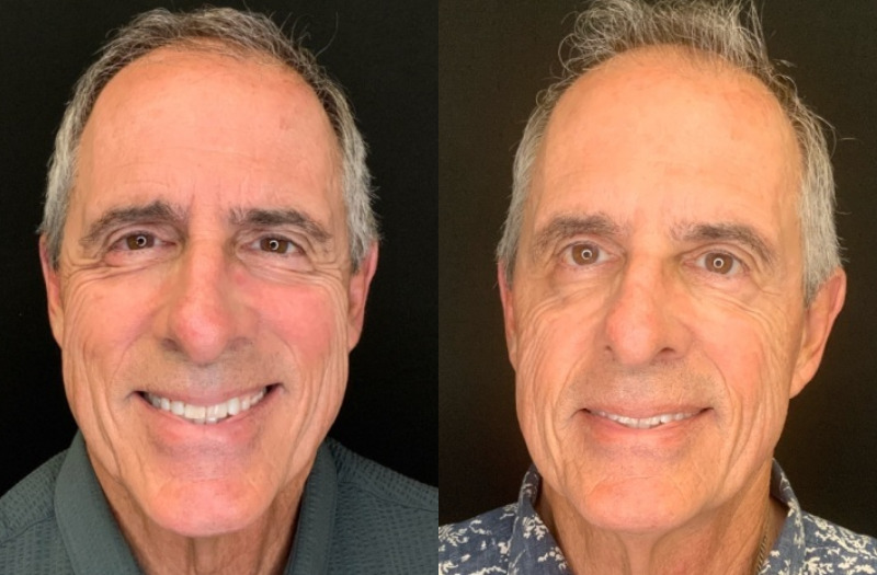 Patient #12546: Botox Combine Image