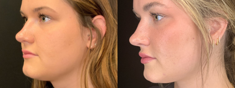 Patient #23485: Lip Flip BOTOX Combine Image