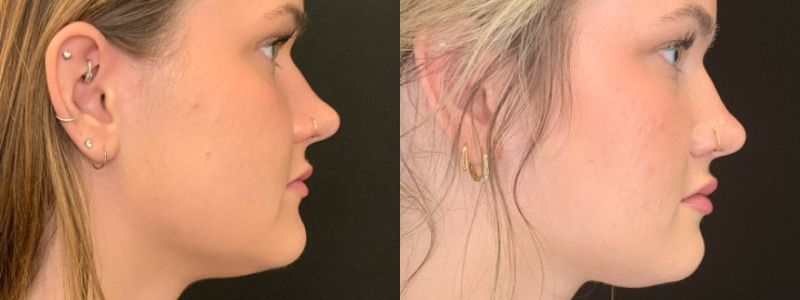 Patient #23485: Lip Flip BOTOX Combine Image