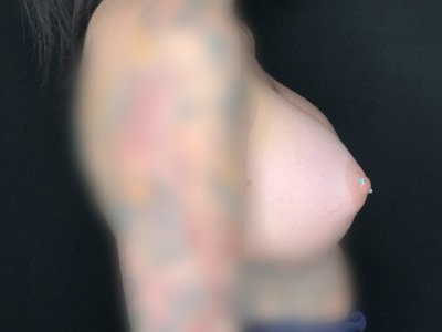 Patient #12587: Breast Augmentation After Image