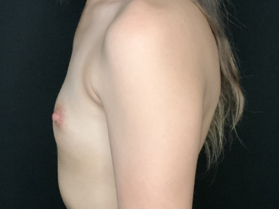 Patient #12547: Breast Augmentation Before Image