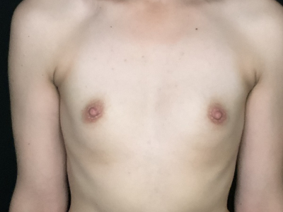 Patient #12547: Breast Augmentation Before Image